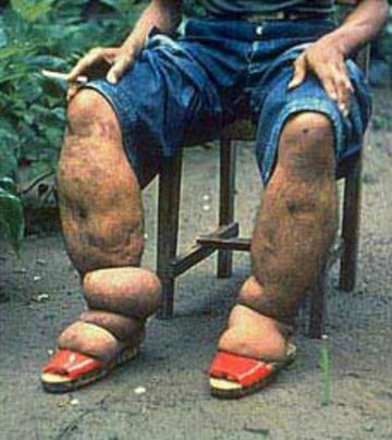 Lymphatic filariasis sufferer