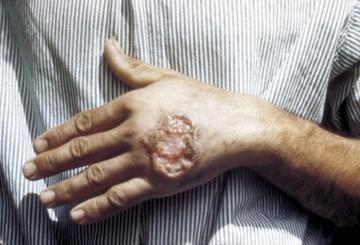 Skin ulcer caused by Leishmaniasis (credit: CDC)