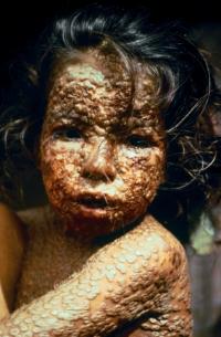 Girl with smallpox in 1973 (CDC)