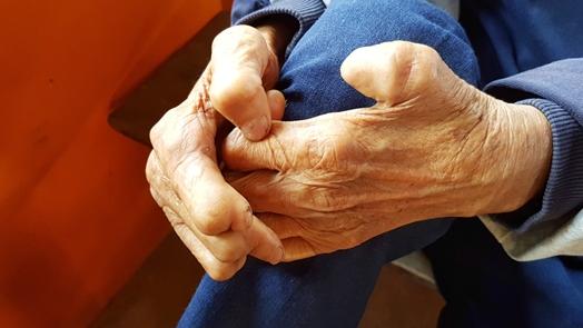 Limb damage caused by leprosy
