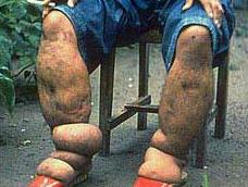 Lymphatic filariasis sufferer