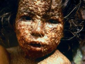 Girl with smallpox in 1973 (CDC)