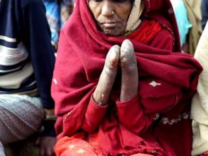 Leprosy sufferer, Munger Leper Colony India