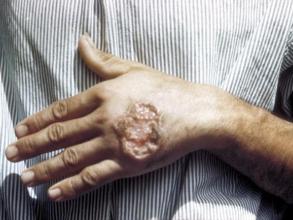 Skin ulcer caused by Leishmaniasis (credit: CDC)